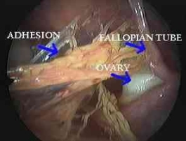 Endometrios Adhesion