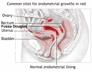 vanliga platser för endometrios