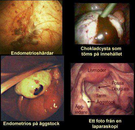 några olika foto som visar hur Endometrios kan se ut