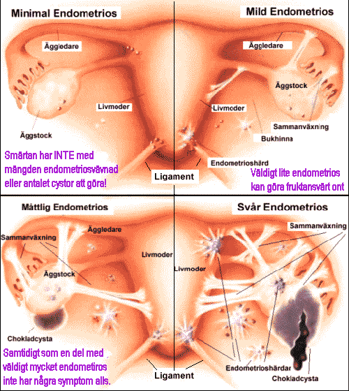 4 tecknade bild som visar en livmoder med omkringliggande organ samt de olika graderna av Endometrios