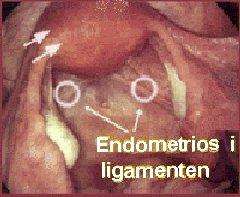 Endometrios på ligamenten