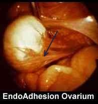 Endo adh ovarium