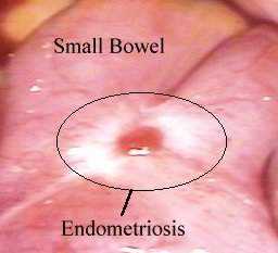 Endo smal bowel