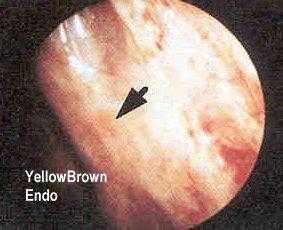 YellowBrown Endo