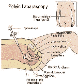 en tecknad bild som visar hur en laparoskopi går till